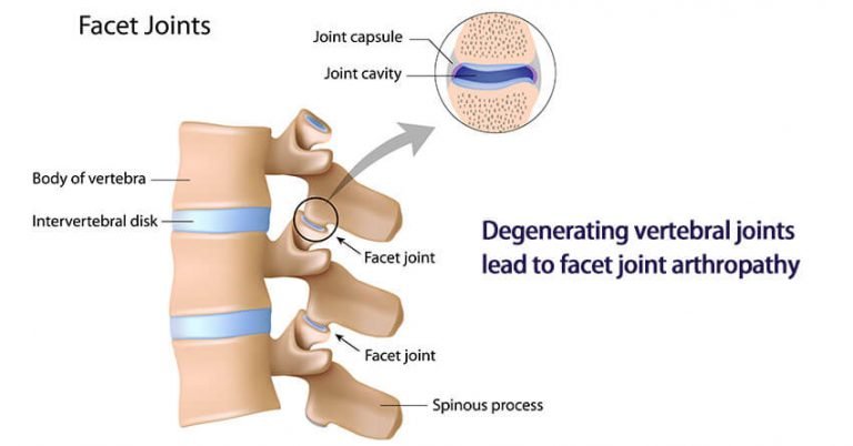 Facet Joint Arthropathy Symptoms Causes Prevention And Treatment