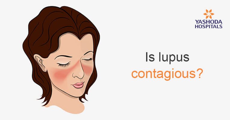 the most frequently asked questions about lupus
