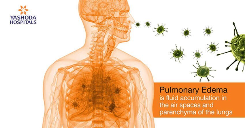 Pulmonology Edema: Excess fluid in the air spaces and parenchyma of the lungs