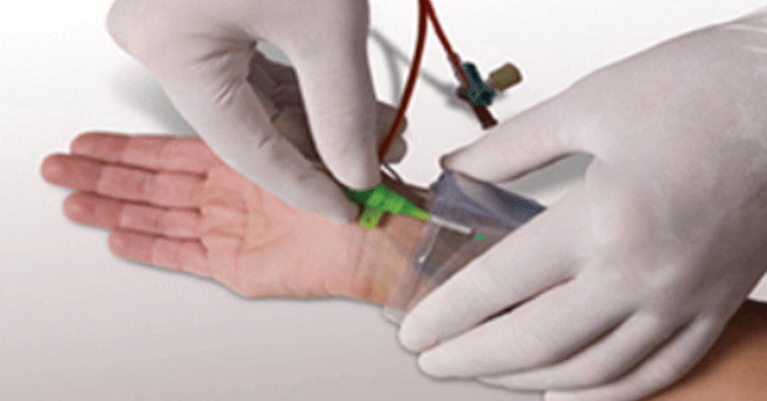 showing the removal of the radial sheath after angioplasty and application of compression using the radial compression band. This band is removed after 5-6 hours, which minimizes the access site complications like bleeding or hematoma formation showing the removal of the radial sheath after angioplasty and application of compression using the radial compression band. This band is removed after 5-6 hours, which minimizes the access site complications like bleeding or hematoma formation