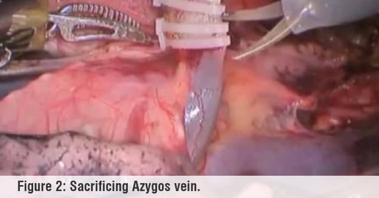 sacrificing azygos vein robotic surgery sacrificing azygos vein robotic surgery