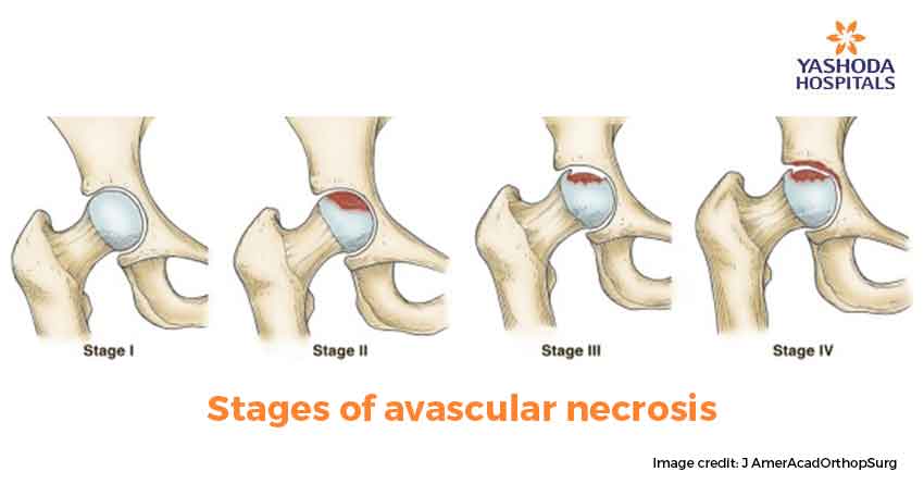 Avascular Necrosis Osteonecrosis Symptoms Causes Types Diagnosis