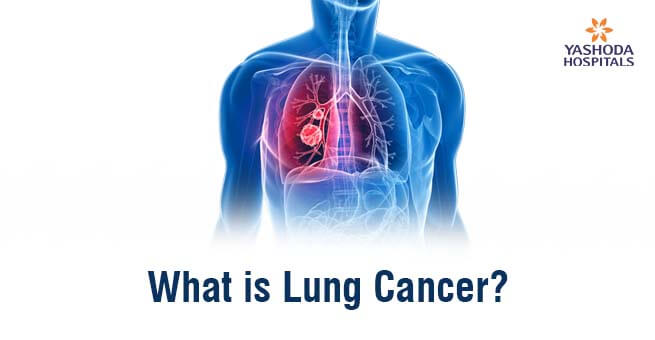 Lung Cancer: Causes, Symptoms, Stages, and Treatment