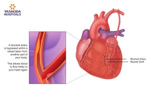 Benefits of Minimally Invasive Cardiac Bypass-Yashoda Hospitals
