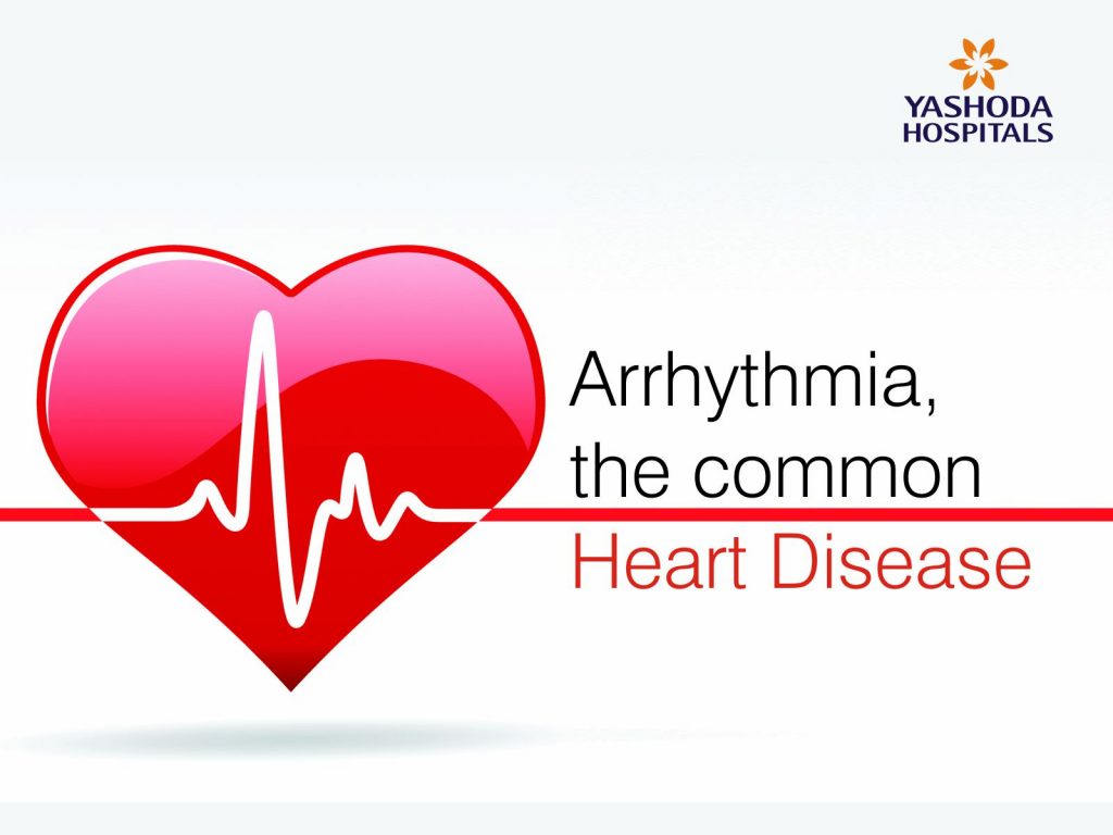 Arrhythmia Disease: Symptoms, Causes And Treatment