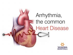 Arrhythmia the common heart disease