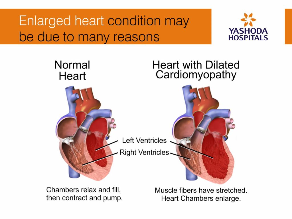 Enlarged heart condition may lead to heart failure, blood clots, heart murmur and cardiac arrest