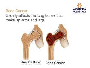 Bone Cancer