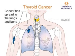 Endocrinal dysfunctions Thyroid Cancer