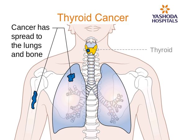 Thyroid Issues After Cancer Treatment