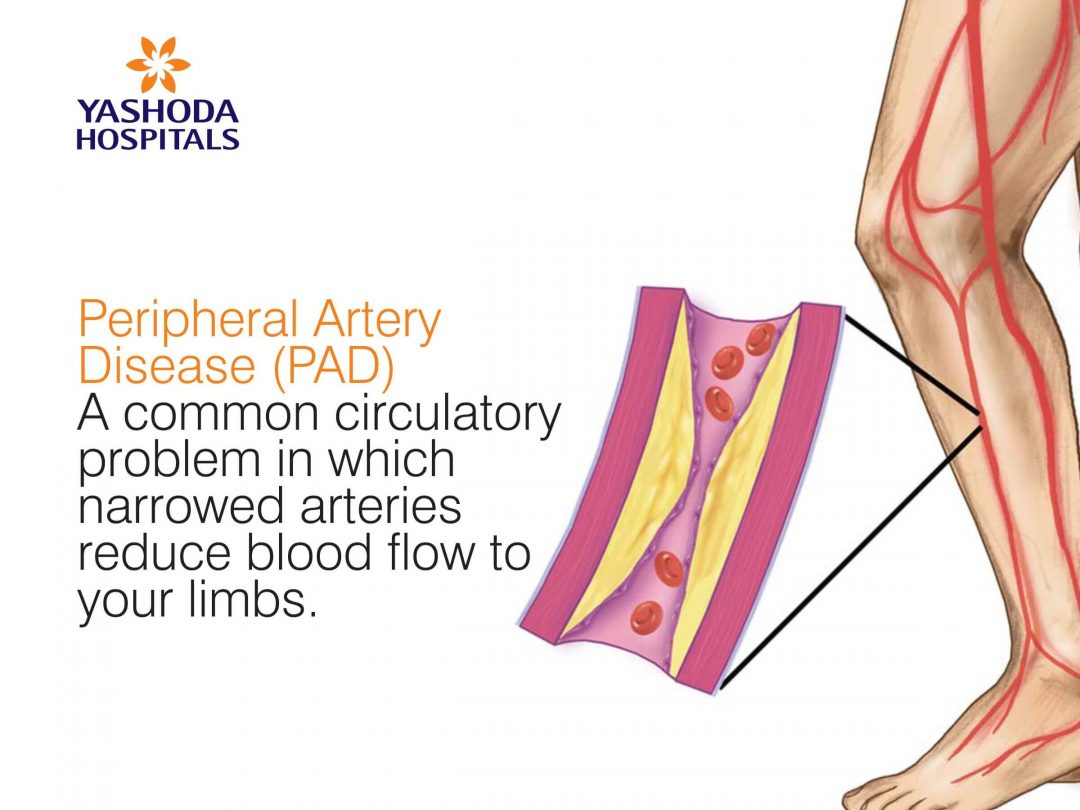 Peripheral Artery Disease (PAD) A Common Peripheral Circulatory Problem ...