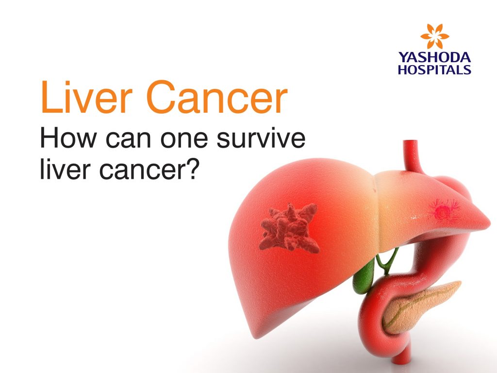 How can one survive liver cancer ? Liver Cancer