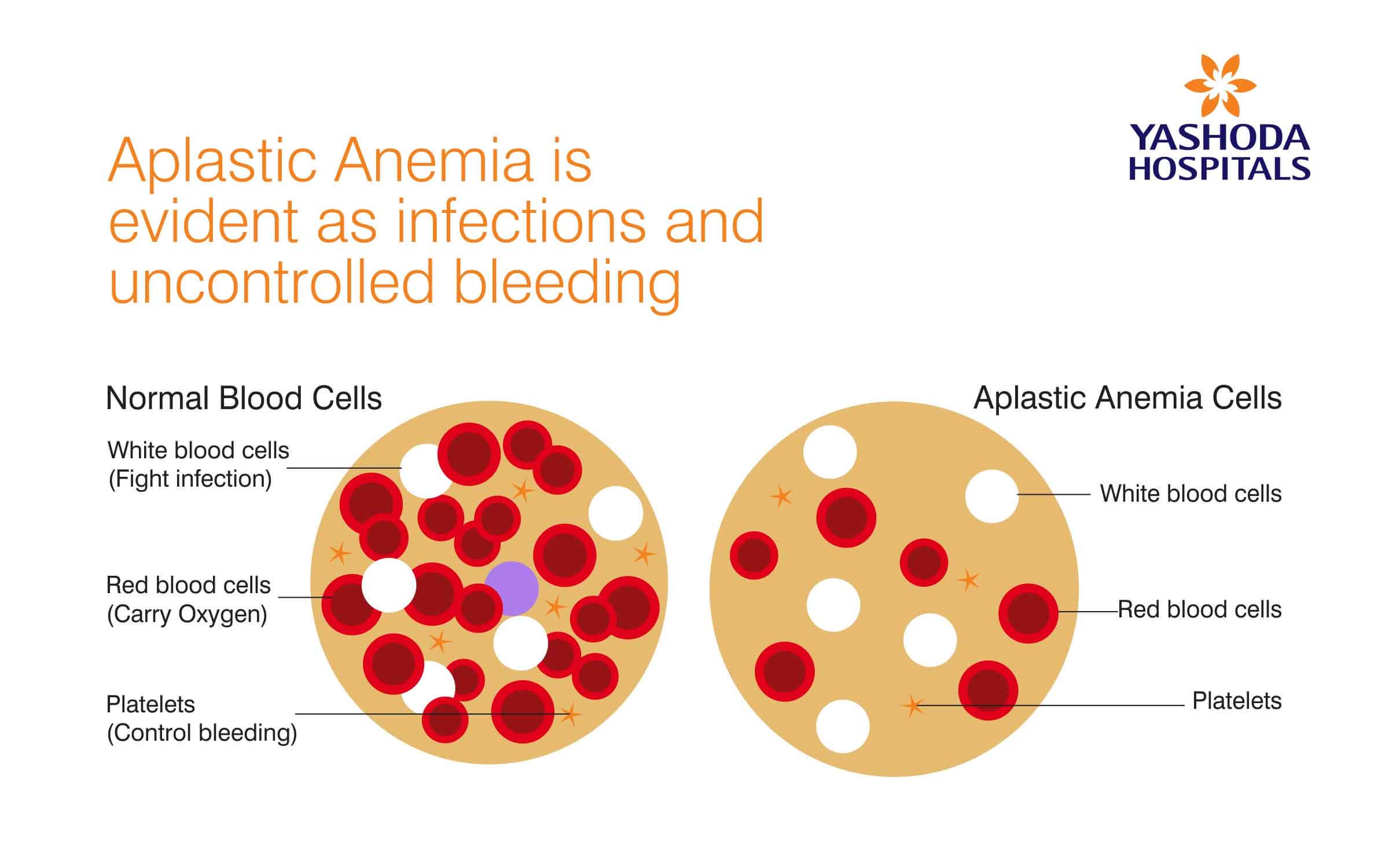 Aplastic Anemia is evident