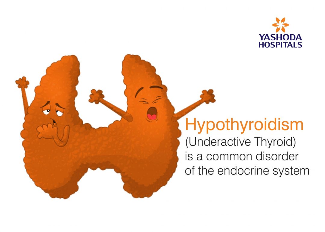 Hypothyroidism Symptoms Causes Diagnosis And Treatment