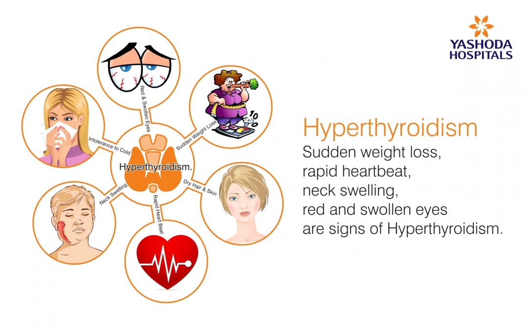 Hyperthyroidism Symptoms Causes Diagnosis And Treatment Yashoda Hospitals