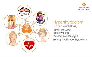 signs of Hyperthyroidism