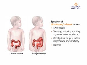 Symptoms of Hirschsprung’s Disease