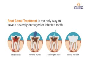 Root Canal is used to treat infection