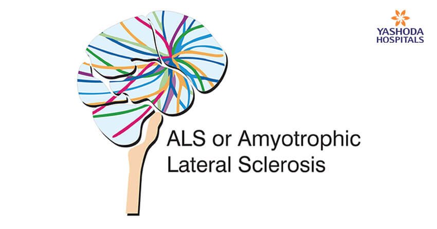 Amyotrophic lateral sclerosis