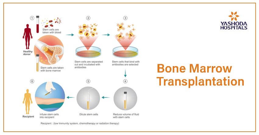 Advanced-Bone-Marrow-Transplant