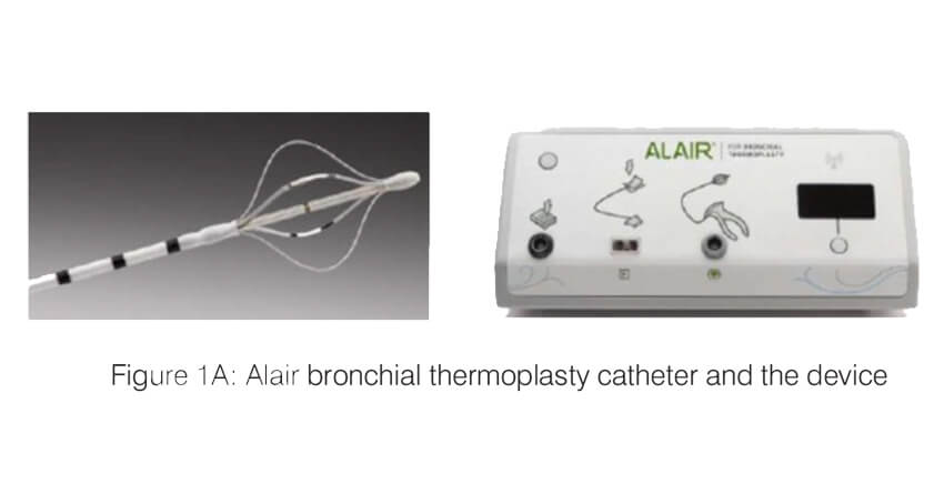 Alair bronchial thermoplasty catheter and the device