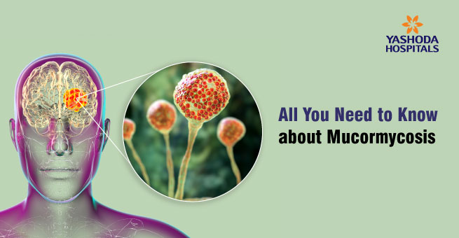 All You Need to Know about Mucormycosis