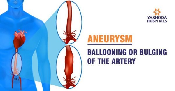 Aneurysms Its Causes Symptoms Diagnosis And Treatment 0372