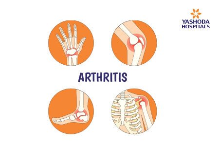 Arthritis Arthritis: What