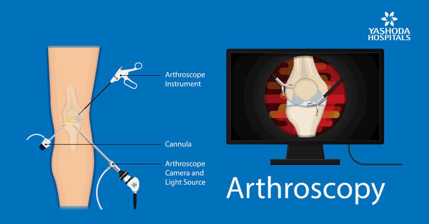 Anterior Cruciate Ligament Tear(ACL) Injuries: Symptoms, Diagnosis and ...