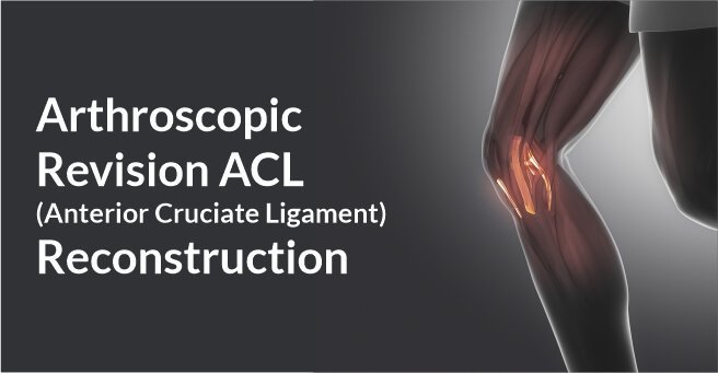 Arthroscopic Revision ACL (Anterior Cruciate Ligament) Reconstruction