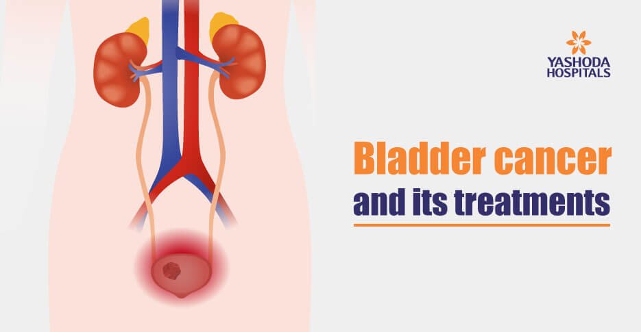Bladder cancer and its treatments