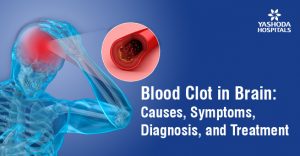 Blood Clot In Brain Causes Symptoms Diagnosis And Treatment