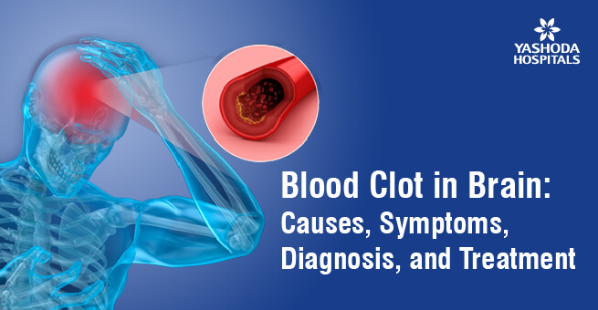 Blood Clot in Brain: Causes, Symptoms, Diagnosis, And Treatment