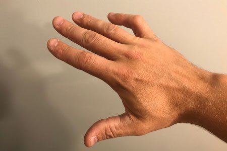 Deformity boutonniere Boutonniere Finger