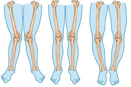 familie walgelijk Samenwerken met Bowed Legs: Symptoms and Complications