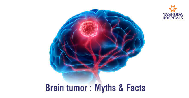 Brain tumor : Myths & Facts