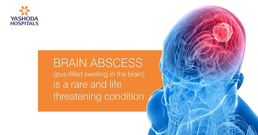 Brain abscess (pus-filled swelling in the brain) is a rare and life threatening condition