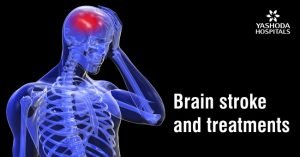 Brain Stroke: Symptoms, Types, Risk Factors, Diagnosis and Treatment