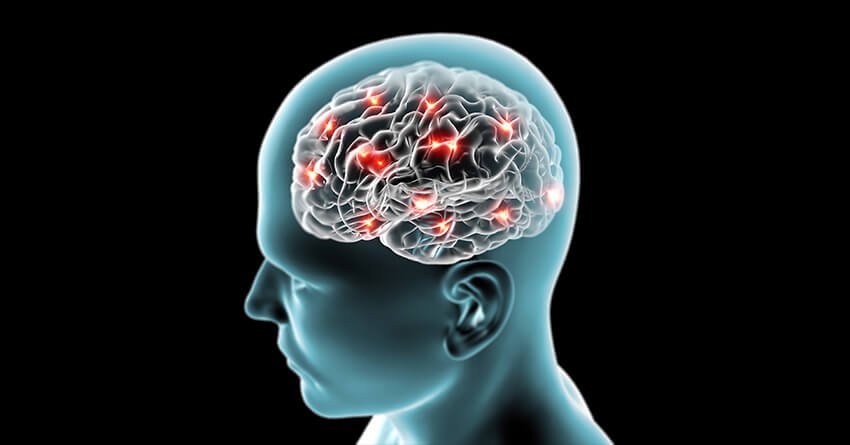 Brain stroke-blockage in the brain nerves