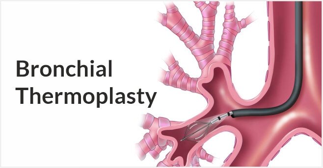 Bronchial Thermoplasty case-study