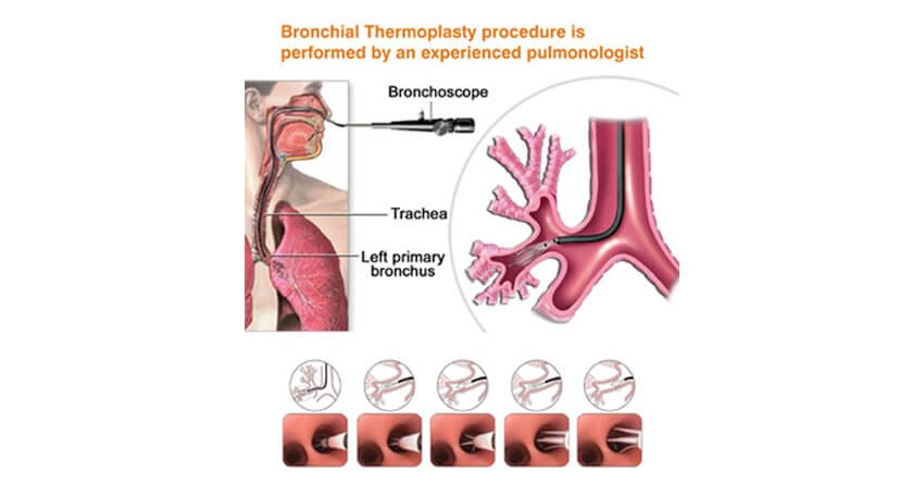 Bronchial thermoplasty procedure
