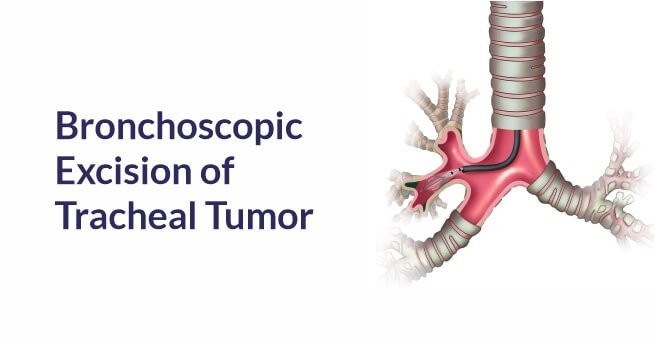 Bronchoscopic Excision of Tracheal Tumor case-2
