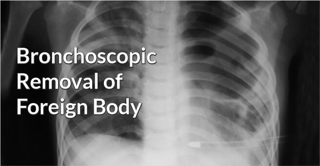 Bronchoscopic Removal of Foreign Body