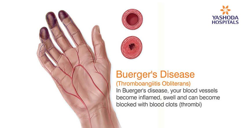 What is Buerger s disease Causes Symptoms Risk 