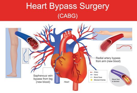 Coronary Artery Bypass Grafting (CABG)