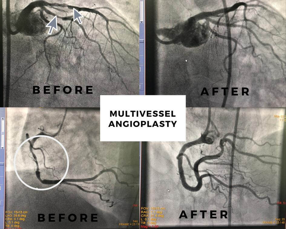 CABG for multivessel Angioplasty