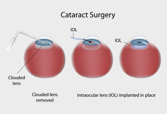 Cataract Surgery Cost in Hyderabad