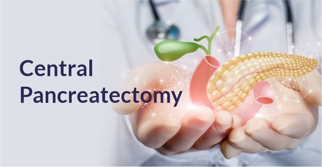 Central Pancreatectomy