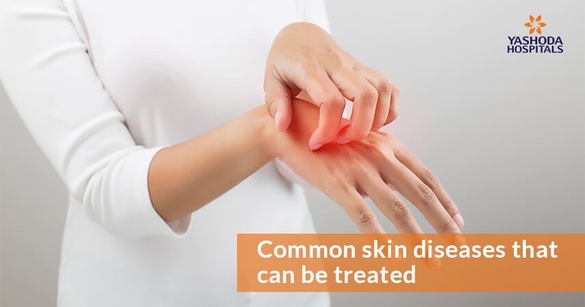 Common skin diseases