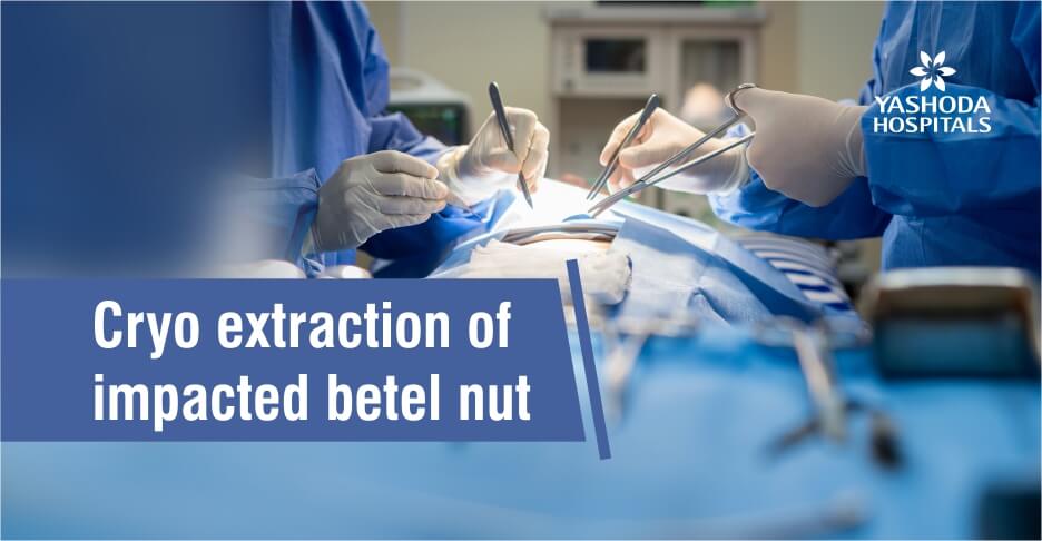 Cryo extraction of impacted betel nut